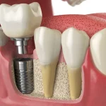 Navigating the Emotional Journey of Receiving Dental Implants