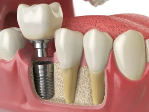Navigating the Emotional Journey of Receiving Dental Implants