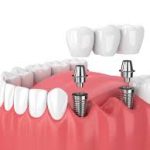 Navigating the Emotional Journey of Receiving Dental Implants