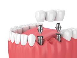 Navigating the Emotional Journey of Receiving Dental Implants