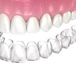 How Invisalign Aligner Storage Practices Preserve Material Integrity Between Wearing Cycles