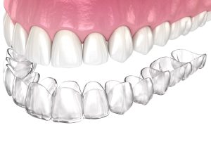 How Invisalign Aligner Storage Practices Preserve Material Integrity Between Wearing Cycles